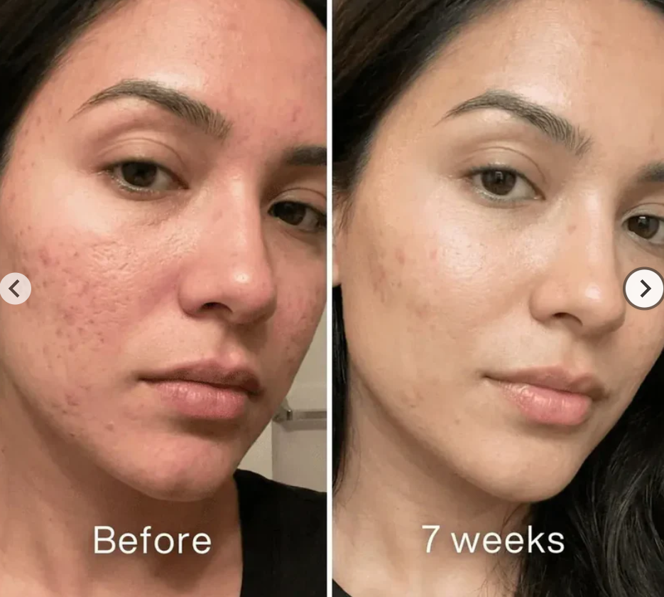Neylona™ Clinical Scar Repair