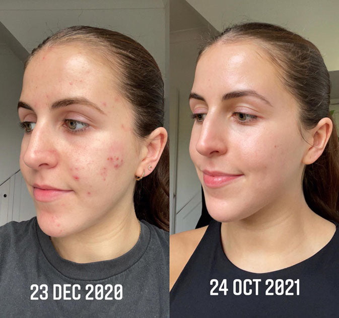 Neylona™ Clinical Scar Repair
